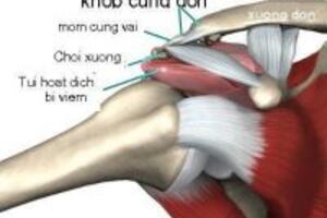 “Viêm khớp vai” và những phương pháp điều trị