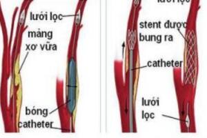 Nong và đặt Stent động mạch cảnh
