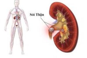 Cách dùng lá Giang để chữa sỏi thận