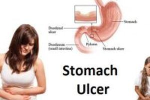 Nghiên cứu chứng minh tinh bột nghệ chữa đau dạ dày hiệu quả