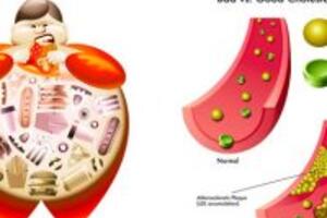 Sự thật về bài thuốc chữa mỡ máu từ cây diệp hạ châu