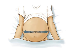 Tràn dịch ổ bung – Cổ trướng