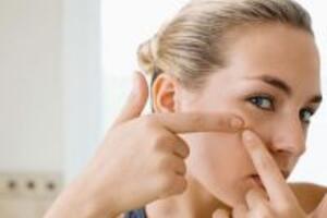 Những tips chăm sóc da mụn cho “teen lười”