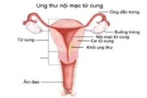 Ung thư nội mạc tử cung