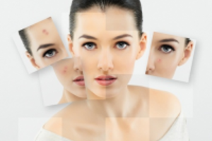 Công thức trị mụn hiệu quả nhất từ lòng đỏ trứng gà