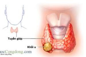 Ung thư tuyến giáp