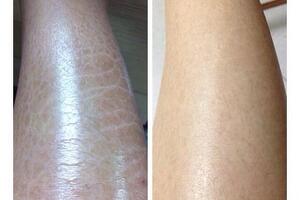 Cách chăm sóc và điều trị da chân khô