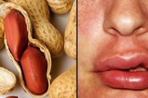 Hạt đậu phộng ngon lành là thế, nhưng nhiều người có thể chết do dị ứng nó