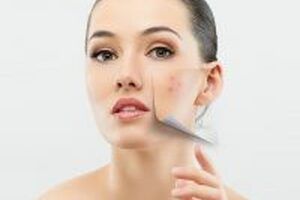 4 bước tự chế mặt nạ trị mụn siêu an toàn tại nhà