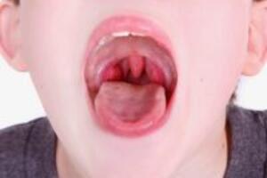 Những bài thuốc chữa viêm họng cực hiệu quả mà ít người biết