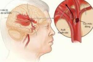 Xuất huyết não là gì