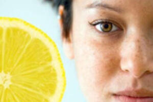 Mách bạn công thức trị nám da với nước cốt chanh