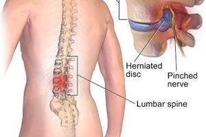 Triệu chứng và biện pháp xử trí bệnh thoái hóa khớp và cột sống