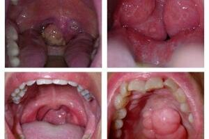 Những điều cần biết về ung thư vòm họng