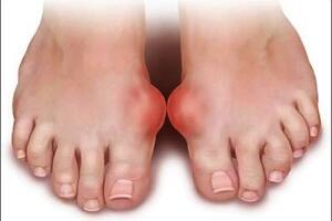 Bệnh Gout: Cơ chế sinh bệnh như thế nào?