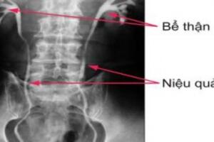 Chụp X quang hệ tiết niệu bằng đường tĩnh mạch