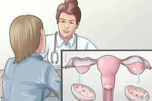 Đa nang buồng trứng có nguy hiểm không?