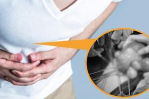 Đau bụng 2 tháng mới đi khám, người phụ nữ không ngờ phải cắt bỏ nửa tử cung