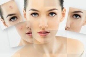 Cách chữa vết thâm bằng nguyên liệu dễ kiếm