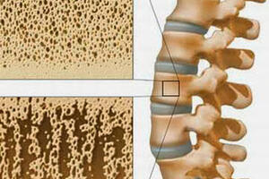Biến chứng của bệnh tiểu đường ảnh hưởng gì đến xương khớp