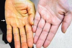 Da vàng, mắt vàng có phải bệnh gan?