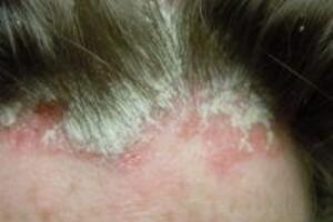 Cách trị bệnh vảy nến trên da đầu bằng tinh dầu sả