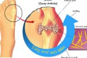Những giai đoạn bệnh gout và cách điều trị hiệu quả mà bạn nên biết