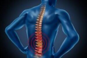 Phát hiện bài thuốc trị bệnh gai cột sống cực hiệu quả