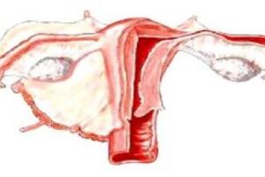 Điều trị ung thư buồng trứng biểu mô