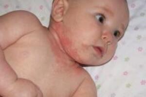 Cách trị bệnh chàm bội nhiễm ở trẻ em