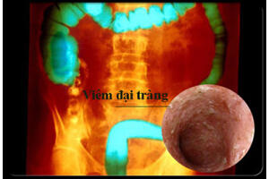Bệnh đại tràng: Trị triệu chứng là chưa đủ