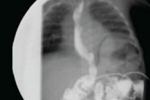 Chụp X quang cản quang ống tiêu hóa trên với Barium