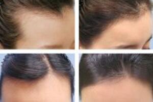 Cách trị rụng tóc từ cây cỏ quanh nhà