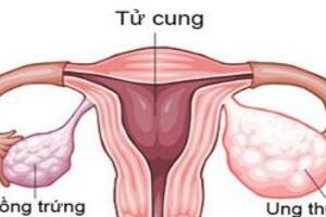 Tầm soát ung thư buồng trứng