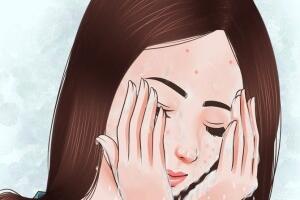 Phương pháp trị mụn đầu đen an toàn hiệu quả