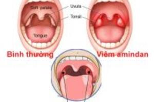 Viêm amidam cấp tinh và mãn tính có biểu hiện và biến chứng nào?
