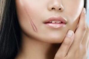 Một số lưu ý cần biết khi điều trị sẹo