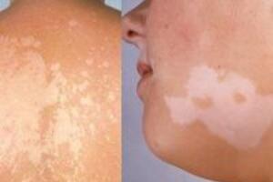 Sự lầm tưởng giữa bệnh lang ben và bệnh bạch biến