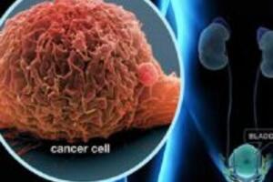 Bệnh ung thư bàng quang HÃY kiêng ăn 10 loại thực phẩm sau đây