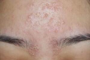 Nguyên nhân và những cách trị mụn cơm bằng nguyên liệu thiên nhiên