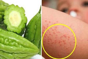 Điều trị rôm sảy bằng phương pháp dân gian