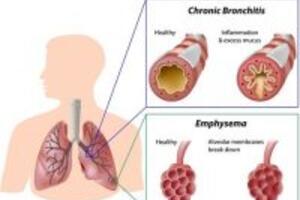 Những biến chứng nguy hiểm của bệnh giãn phế quản đối với sức khỏe
