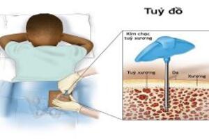 Chọc hút tủy xương hoặc sinh thiết tủy xương dưới gây mê
