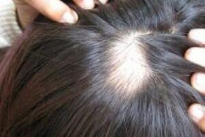 Bị rụng tóc từng mảng phải làm sao?