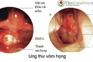 Ung thư vòm họng