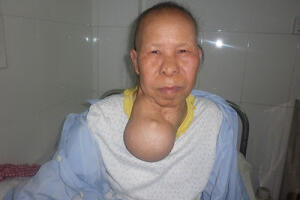 Người đàn bà có bướu cổ to như quả bưởi