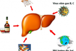 Bệnh nóng gan và những điều bạn cần biết