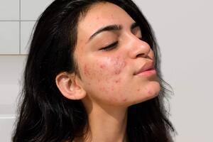 Serum cho da dầu mụn giúp sáng mịn, mờ thâm