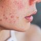 Vì sao bạn skincare rất kỹ mà da vẫn không đẹp?