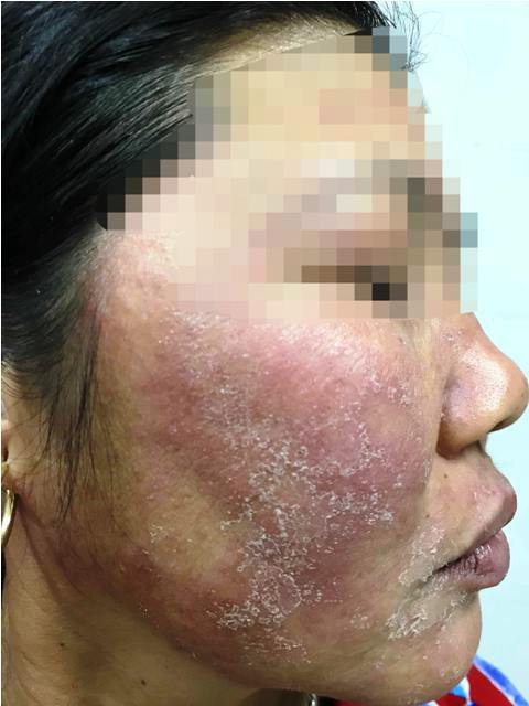 Hãi hùng mặt lở loét, mọc đầy lông vì dùng kem trộn chữa trứng cá, nám má - Ảnh 4. Hãi hùng mặt lở loét, mọc đầy lông vì dùng kem trộn chữa trứng cá, nám má - Ảnh 4.